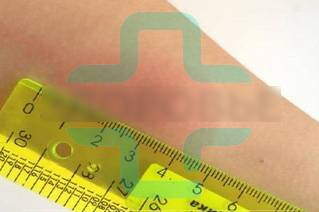 Диаскин тест: что это, как и зачем его проводить? Диаскин тест: что это, как и зачем его проводить?